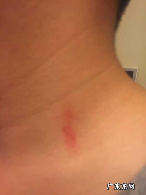 吻痕是什么样子 吻痕是什么