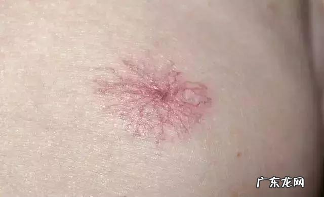 血痣和红痣的区别图片 血痣和红痣的区别