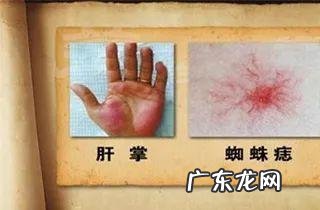 血痣和红痣的区别图片 流血 血痣和红痣的区别图片