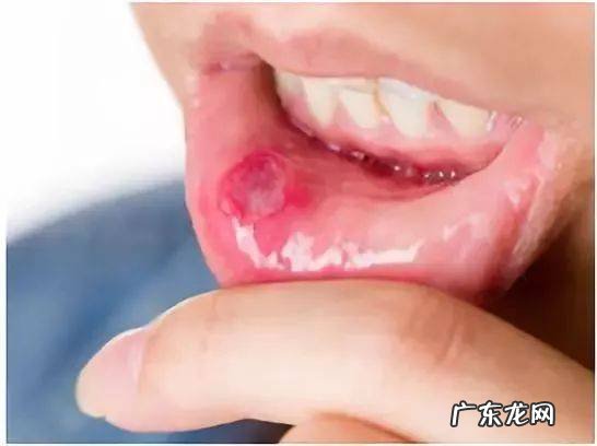 5个小妙招巧治口腔溃疡土办法 5个小妙招巧治口腔溃疡