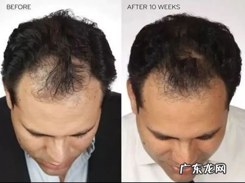 生发秘方 怎样生发最有效