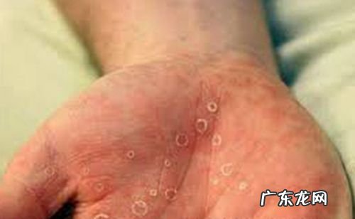 hiv初期症状 hiv初期症状出现时间