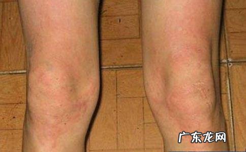 hiv早期症状 hiv早期症状多久出现