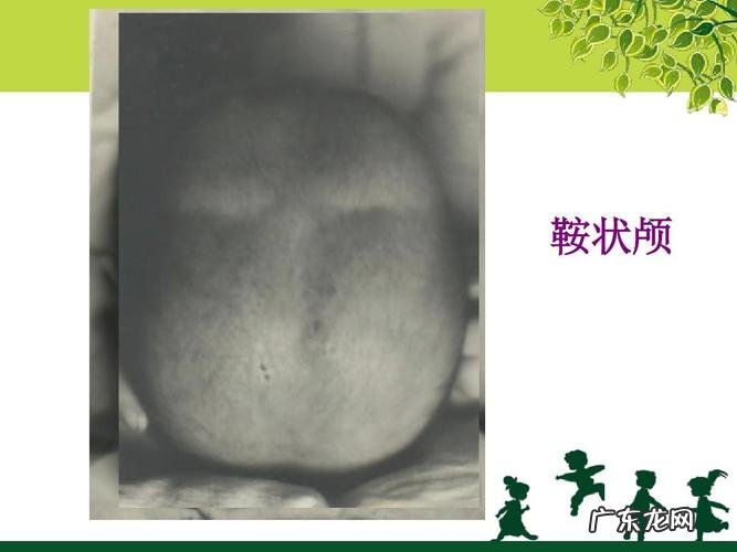 佝偻病的症状图片大全 佝偻病方颅的症状图片